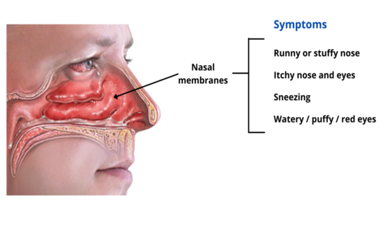 ALLERGIC RHINITIS & NASAL POLYP