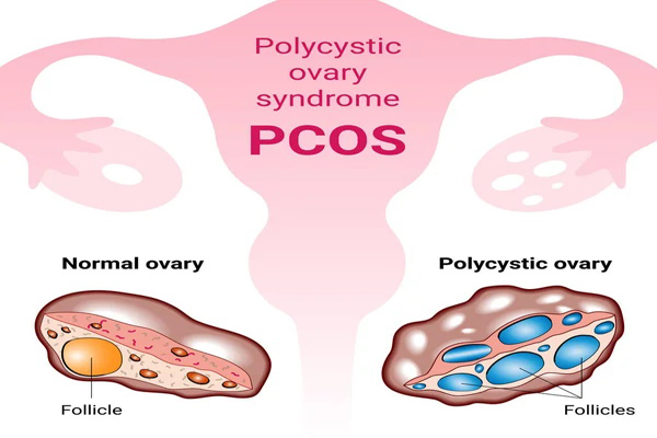 PCOD(POLYCYSTIC OVARIAN)FEMALE SEXUAL PROB.